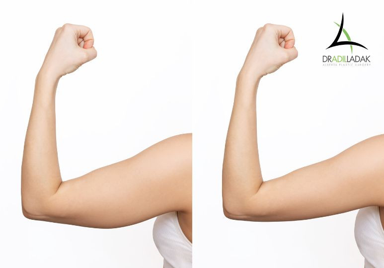 Timeless Arms: Addressing Aging with Brachioplasty